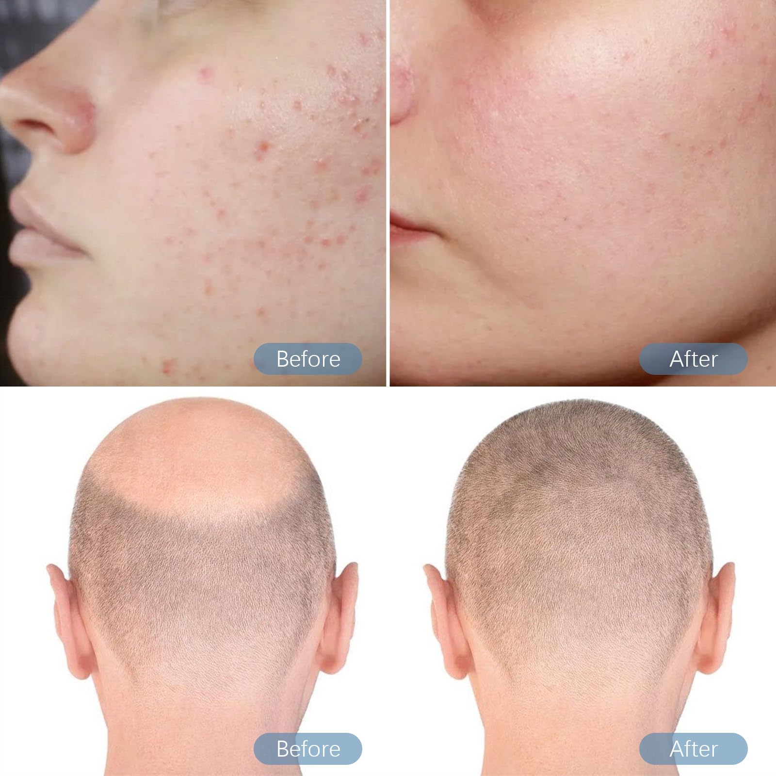 Dr. Pen M8S Microneedling Pen with 20PCS Cartridges